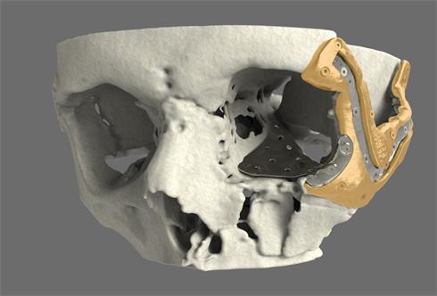 Skull with positioning  guide and implant